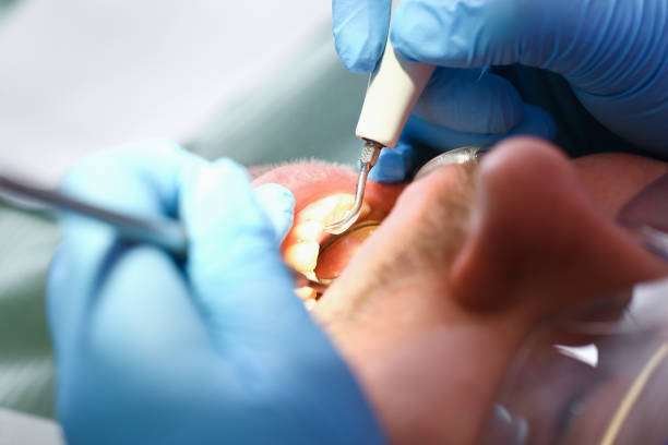Best Emergency Treatment for Dental Infections or Abscesses in Piru, CA
